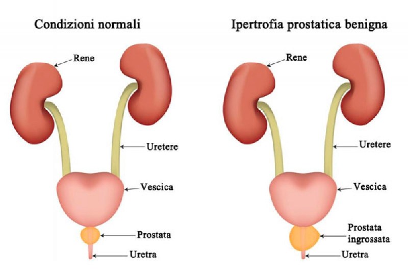 prostata ingrossata dimensioni normali